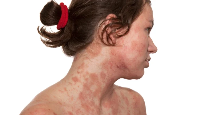 Dermatitis atópica