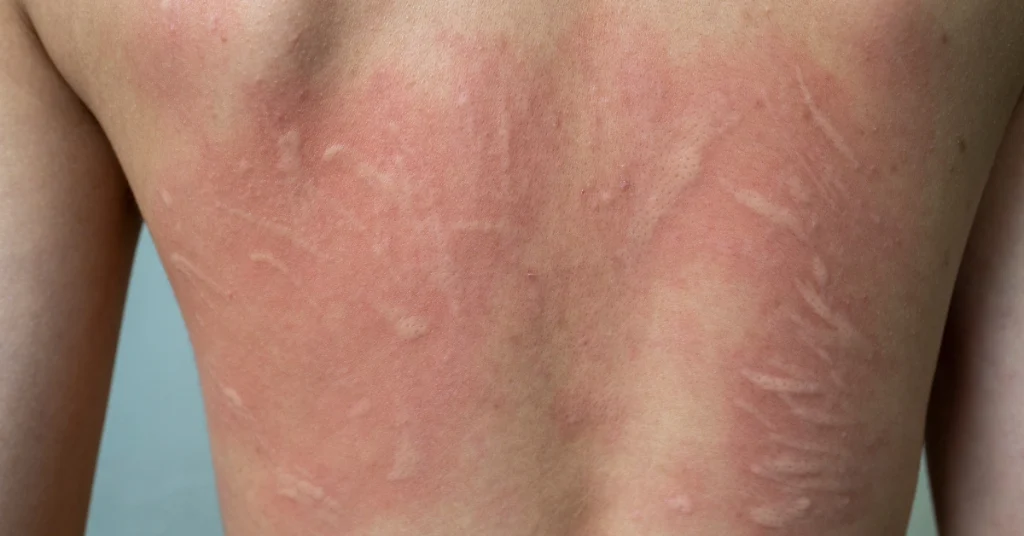 Urticaria y angioedema